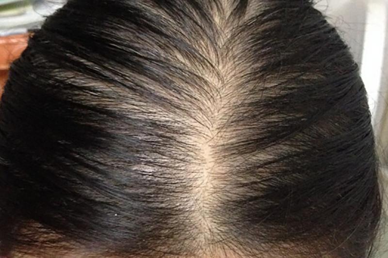 脂溢性脱发中医辨证治疗分两型,脂溢性脱发治疗脱发成功案例