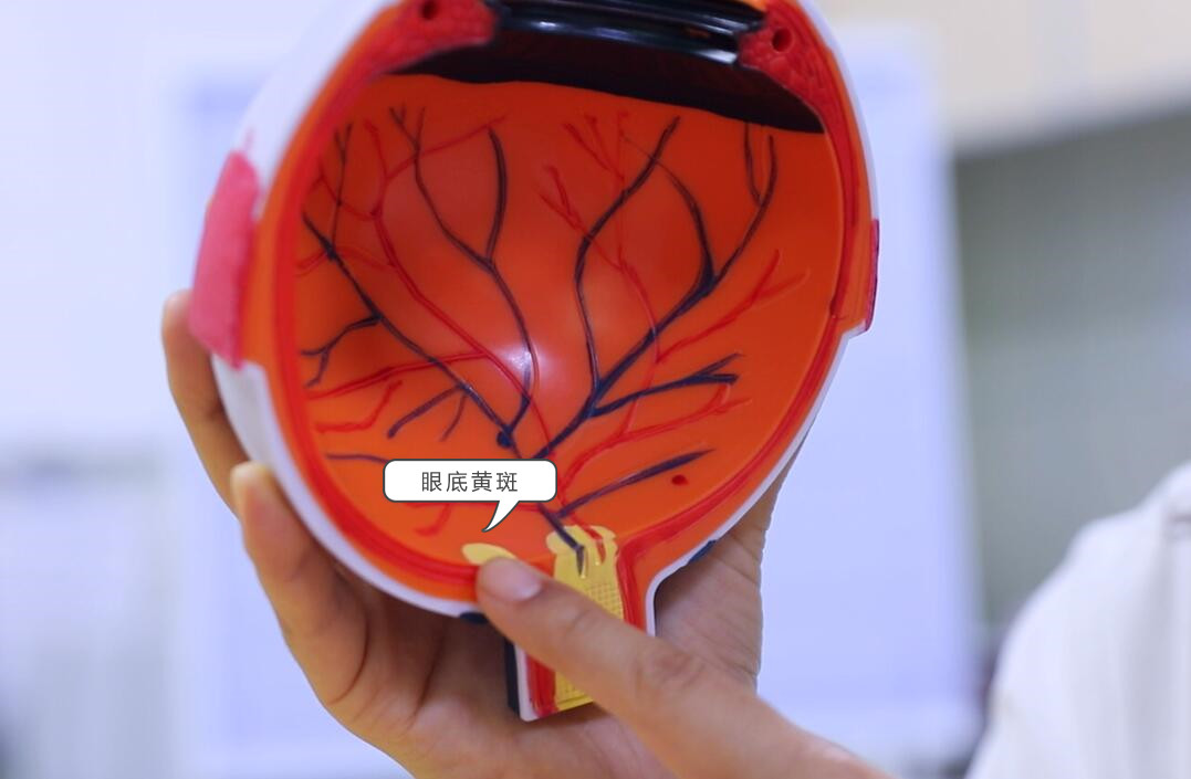 怎样防止眼底黄斑病变,如何简单判断眼底黄斑
