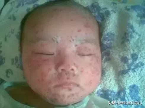 多图！热疹、湿疹、*麻疹荨**、幼儿急疹、水痘…区别和护理