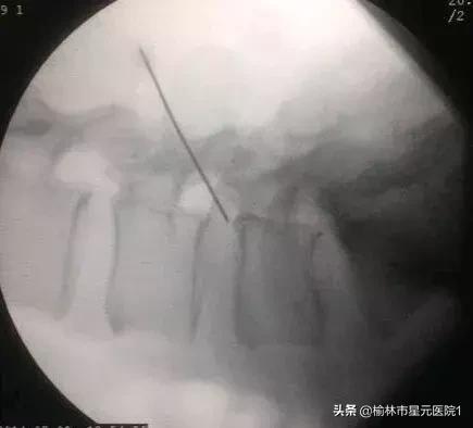 榆林市中医院治腰椎间盘突出症,榆林市治腰椎椎间盘突出