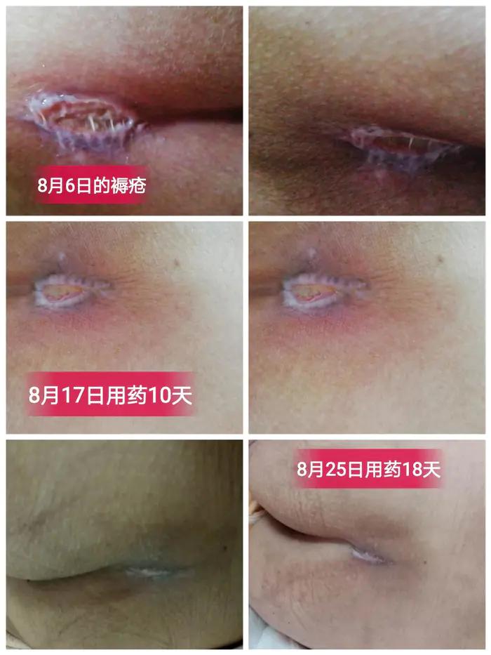 有痔疮的难言之隐,难言之隐的肛肠疾病