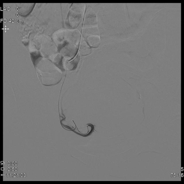 子宫腺肌病保守治疗无效怎么办?