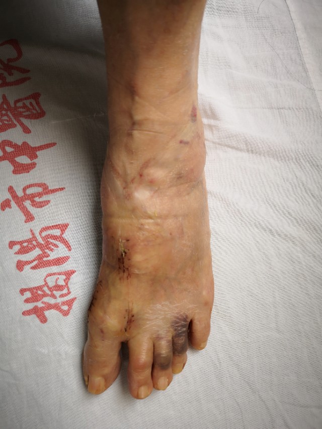 关注足部的健康,关注足部健康