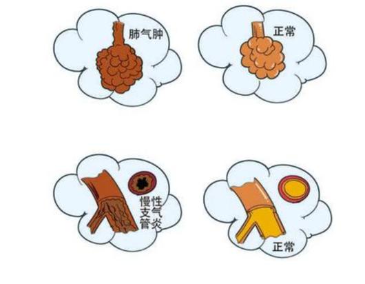 慢阻肺与肺心病有关吗,慢阻肺跟轻度呼吸障碍