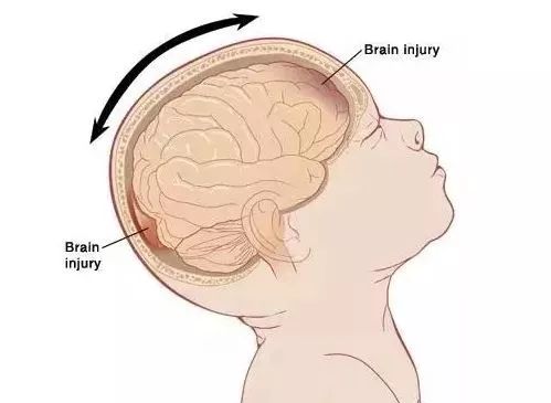 几月内婴儿容易患上摇晃综合征,婴儿摇晃综合征的十大禁忌