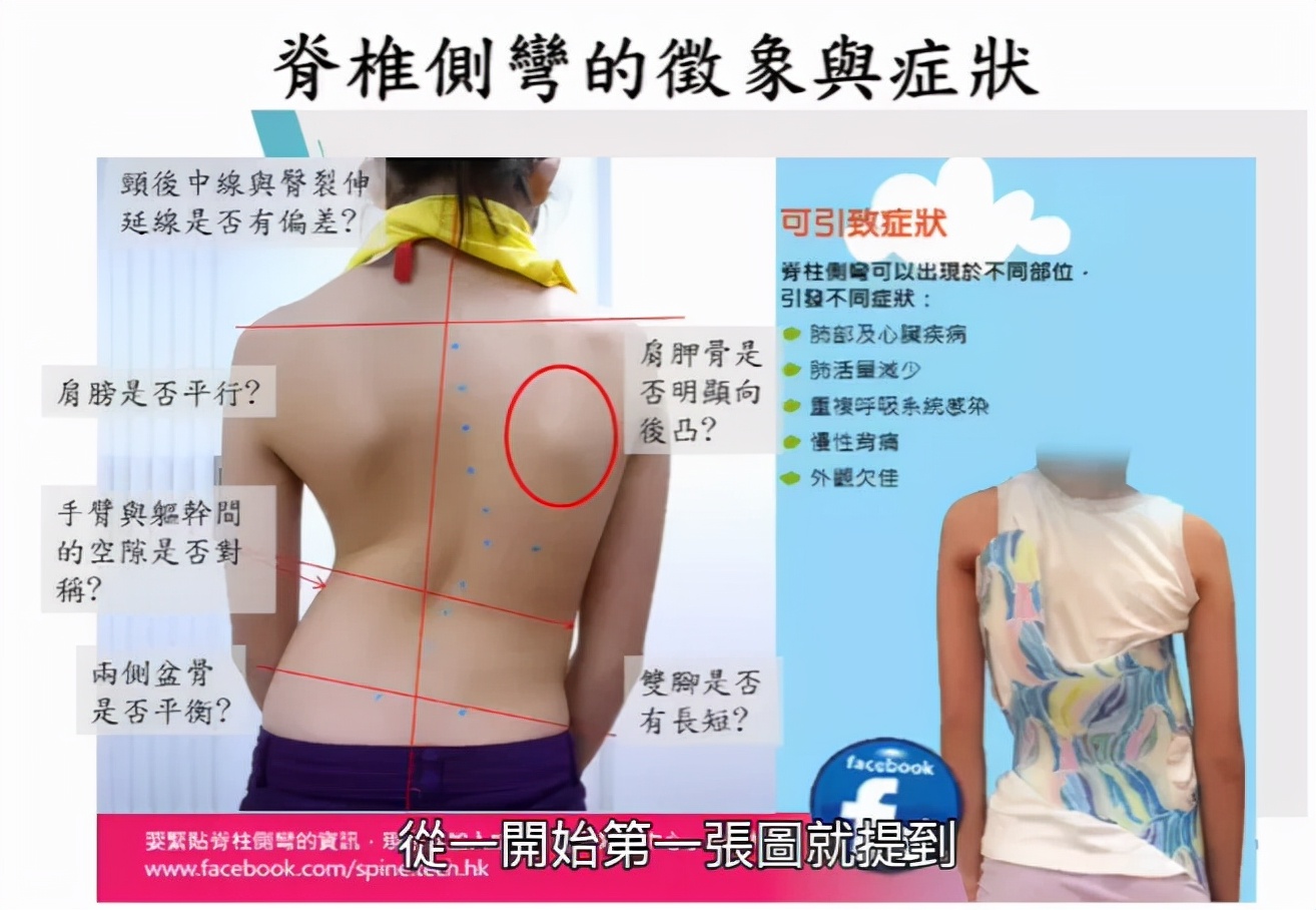 小孩肋骨外翻要不要紧,小孩肋骨外翻用去医院吗