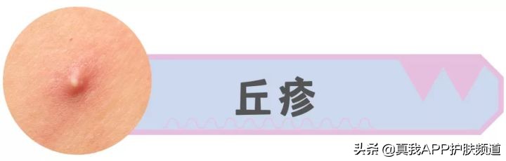 脸上长痘痘反反复复该怎么办,脸上一个部位反反复复长痘痘