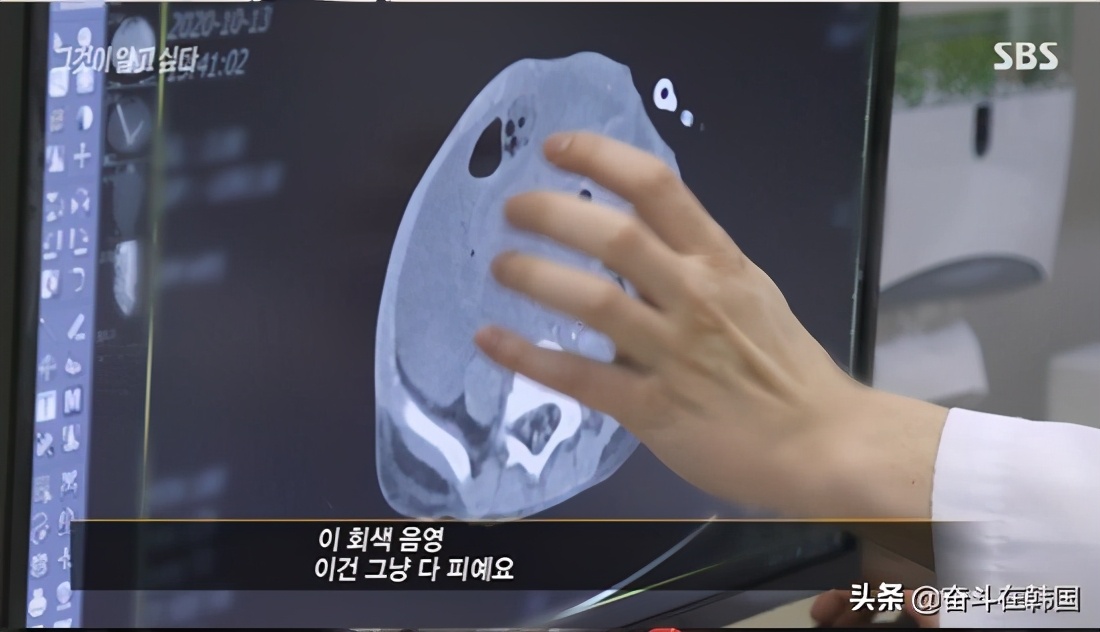 内脏破裂的小孩,腹腔脏器破裂的病人死亡的原因