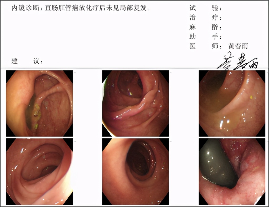 低位直肠癌保肛手术不造瘘利弊,低位直肠癌保肛会影响复发率么