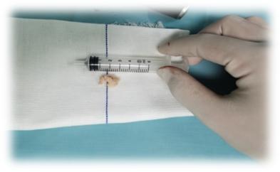 脊柱外科微创融合,脊柱外科微创手术成功案例