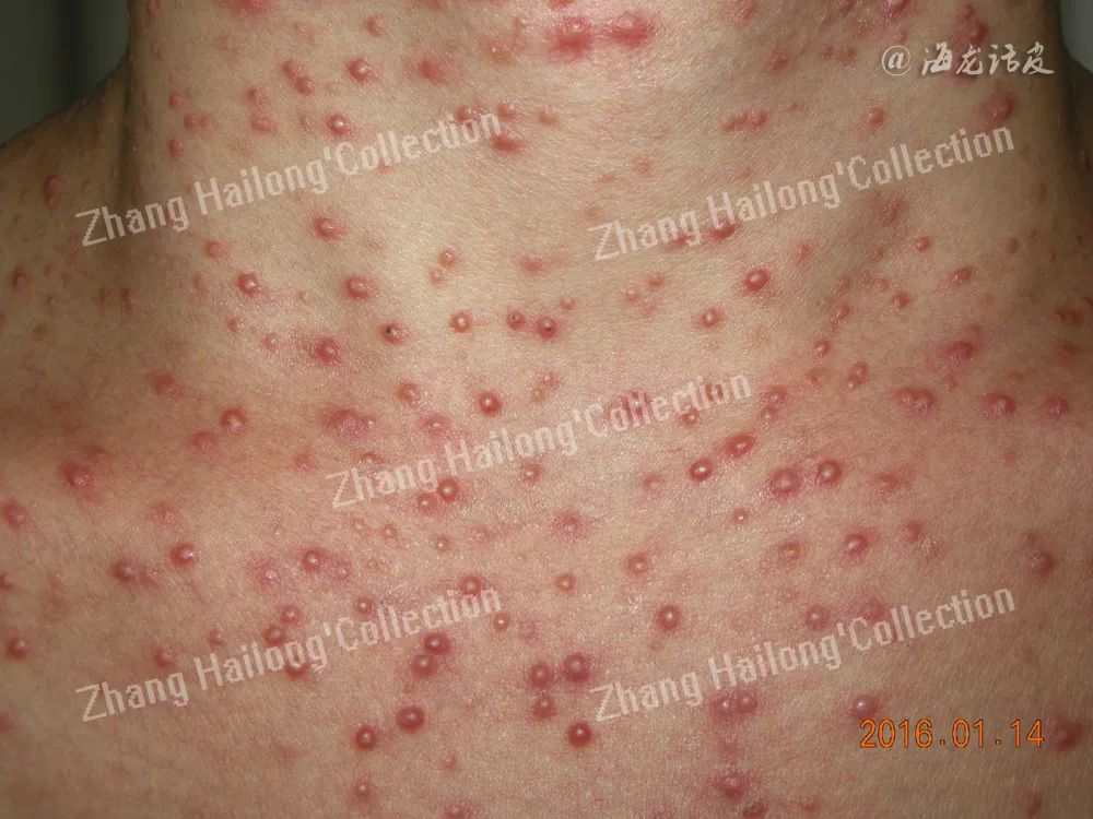 前胸后背长痘是马拉色菌感染吗,胸背部毛囊炎疙瘩大小不一样