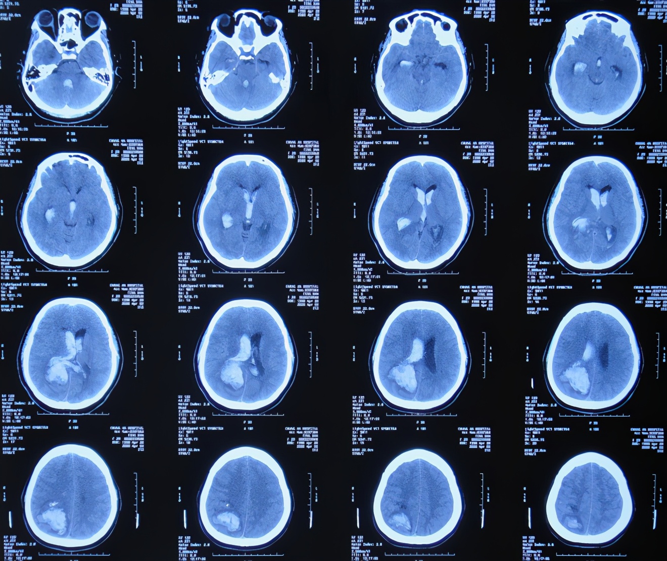 脑室有粘连脑积水有什么办法,脑动脉畸形手术后出现急性脑积水