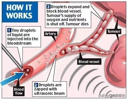 脑血管畸形介入栓塞后并发症,脑血管造影并发症