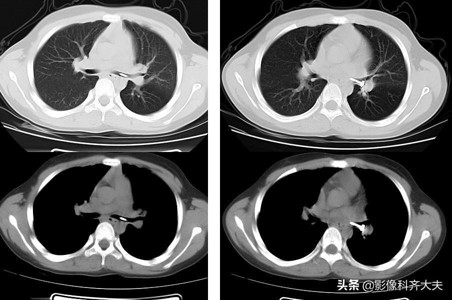 小儿气管镜怎么检查,小儿ct检查全过程视频