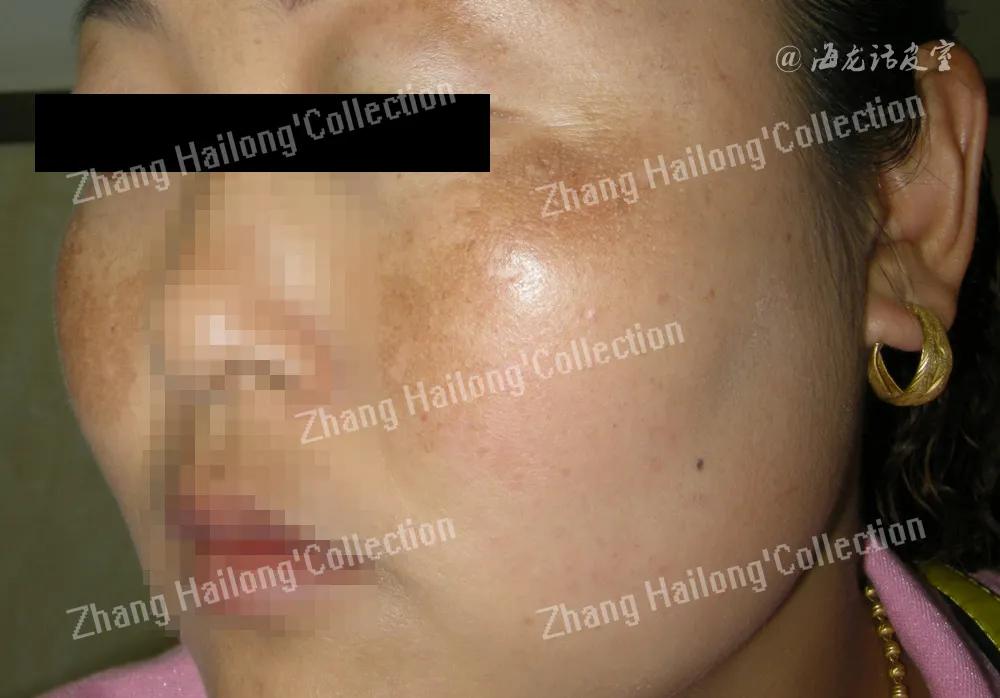 褐斑吃什么药能根除,除褐斑的办法