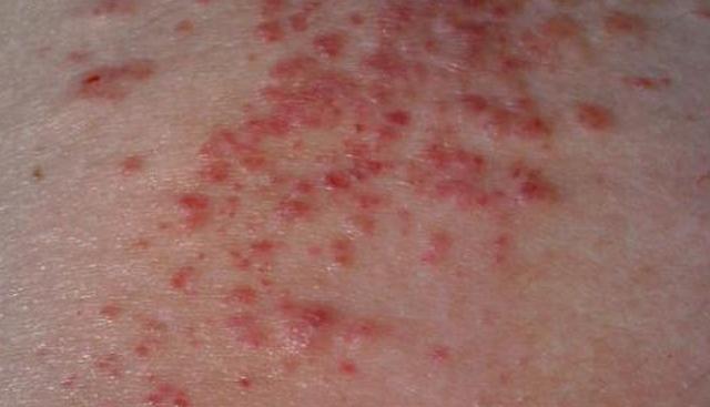 湿疹过来人的独家秘籍,湿疹患者的自救战