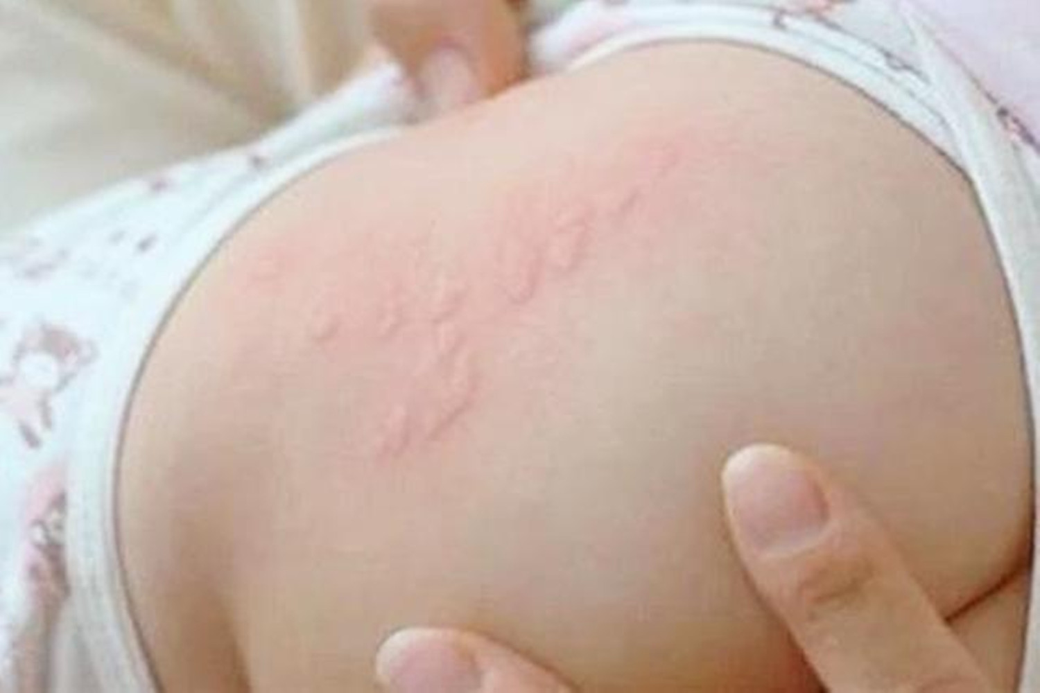 六个月大的宝宝身上起鸡皮疙瘩,10个月大的宝宝身上长满红疙瘩