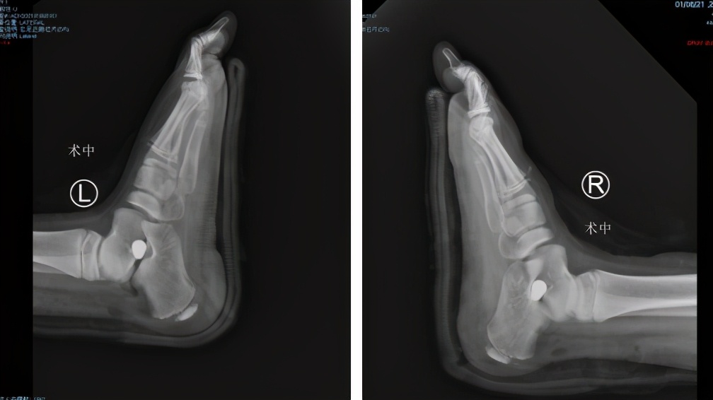 小孩跑步老是摔倒要不要做ct,8岁小孩跑步爱摔跤怎么回事