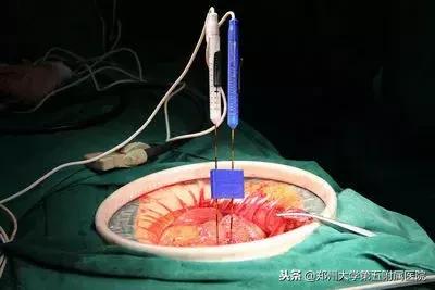 纳米刀消融技术，给胰腺癌患者带来新希望