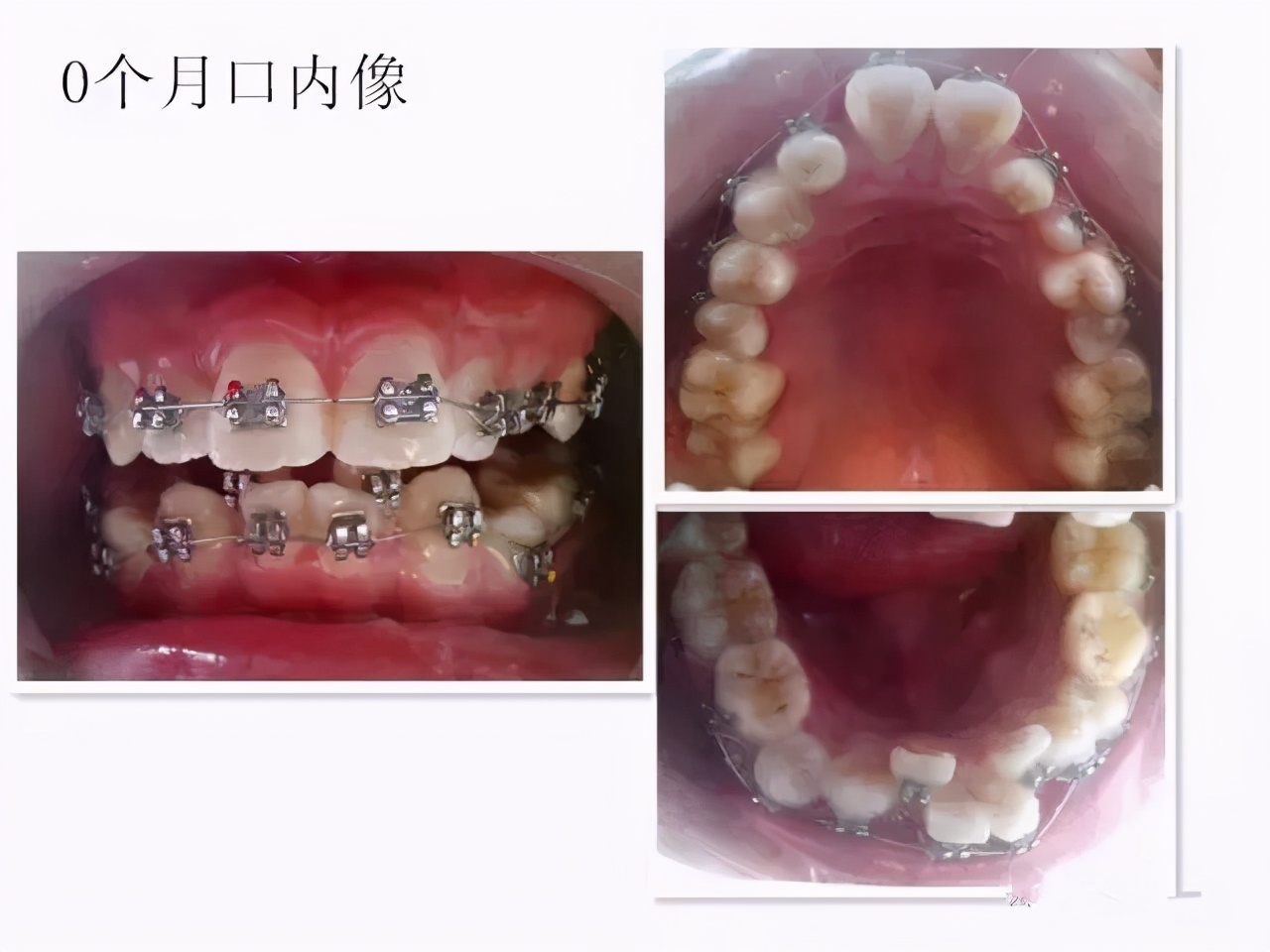 成年人牙齿矫正戴上牙套嘴巴变凸,扩弓会使脸型变大吗