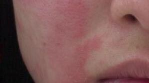 脸发红发烫小妙招有效改善红脸蛋,在暖气屋里脸发红发烫是怎么回事