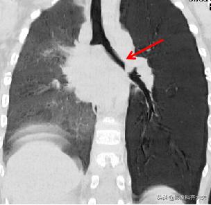 小儿气管镜怎么检查,小儿ct检查全过程视频