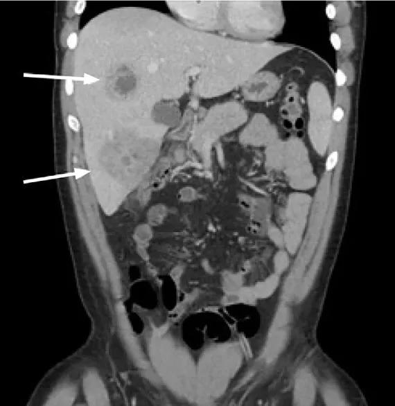这种教科书中才有的阑尾炎并发症，击倒了强壮的健身教练