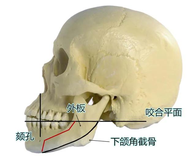 下颌角改善需要注意哪些方面,下颌角术后注意事项