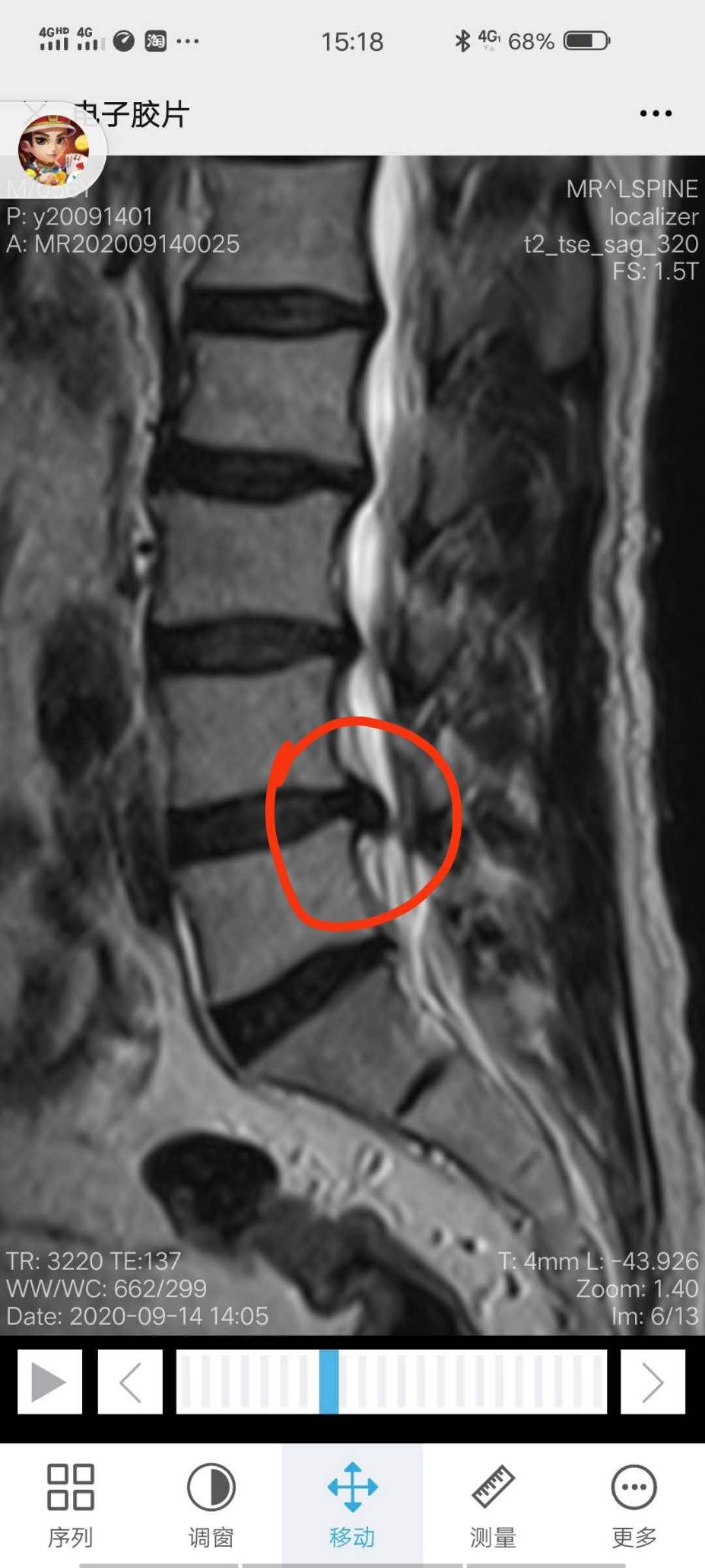 腰痛无法直腰怎么治疗,你还在被疾病困扰吗