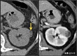 肾癌晚期肺转移痔疮敢动手术吗,肾癌做保肾手术好还是切除手术好