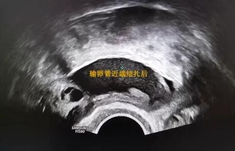 输卵管积水到底该怎么处理?