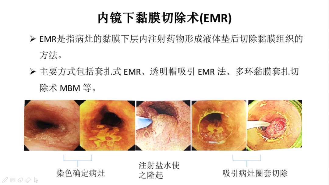 早期食管癌的病变范围是,早期食管癌手术费用多少