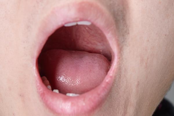 口腔有异味口臭怎么去除,口腔有异味怎么解决口臭