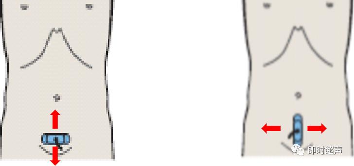 膀胱超声图解大全,膀胱超声解剖及常见病变超声表现