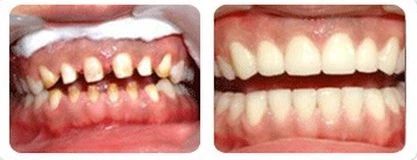 40岁了牙齿龅牙怎么快速矫正,7岁地包天矫正牙齿的全部过程