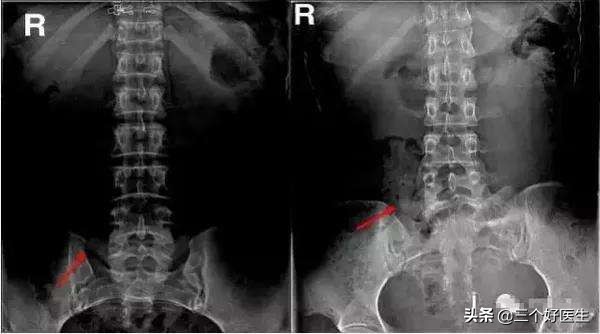 腰椎退行病变腰痛不止怎么办,久治不愈腰屁股腿疼