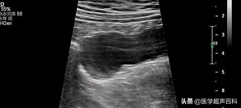 阑尾粘液性肿瘤低度恶性怎么处理,恶性阑尾黏液肿瘤是癌症吗