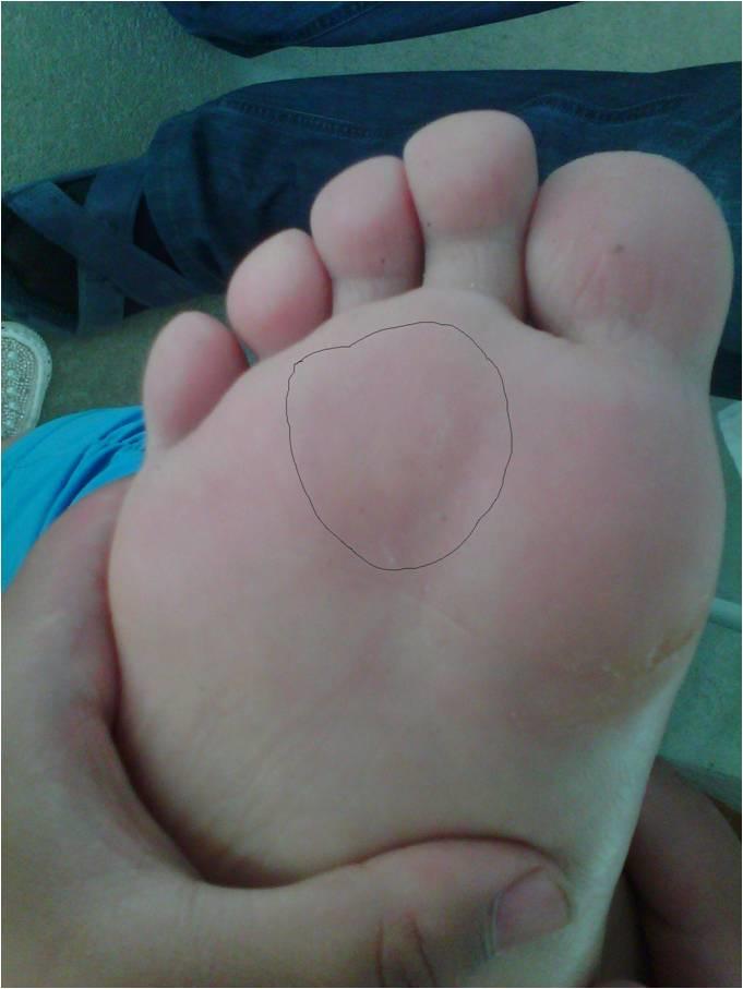 鸡眼掉了会残留吗,鸡眼处理方法推荐