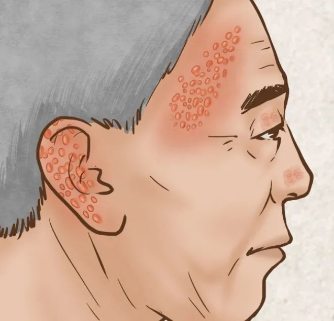 同事长了好多疮会传染吗,同事皮肤病会传染吗