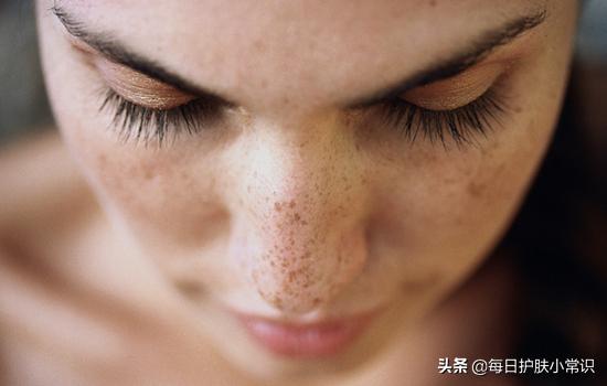 淡斑改善皮肤暗黄,皮肤怎样补水淡斑