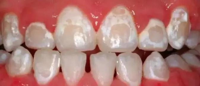 牙齿有白色斑点怎么办,孩子牙齿出现白色怎么回事