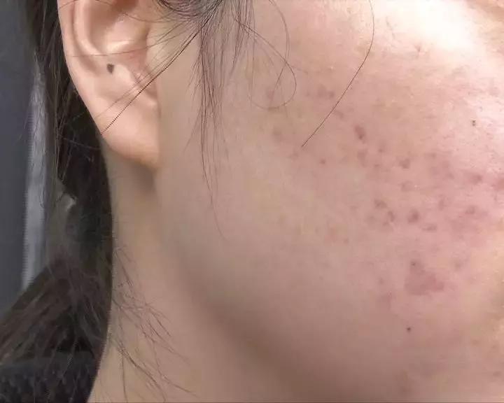 一次美容后她脸烂了!无锡这位女士在整形医院经历了什么……