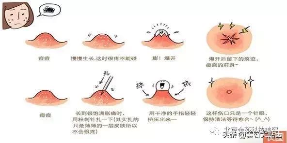 怎么跟自己的痘坑和解,一个痘坑自己在家如何处理