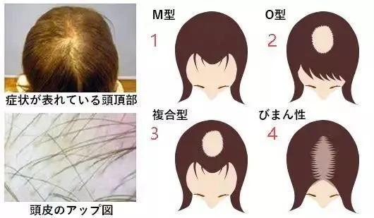 油腻脂溢性脱发,脂溢性脱发怎么抑制出油