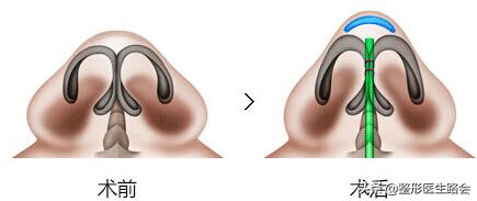 鼻头变厚变大怎么恢复,为什么瘦了鼻头变大