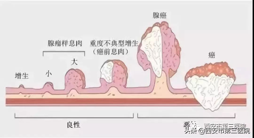 专家医生讲胆囊息肉,息肉是否越切长得越快
