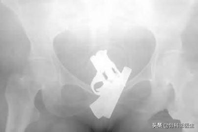 医院取出的异物怎么处理,医生都从患者体内取出过什么异物