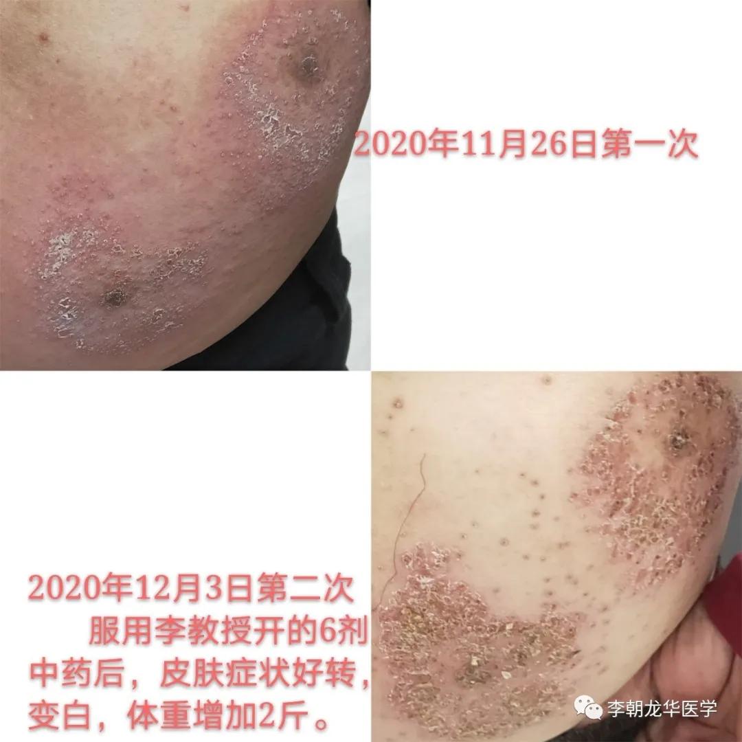 皮肤被虫咬起红包痒有什么能止痒,无名虫咬皮肤奇痒擦什么药