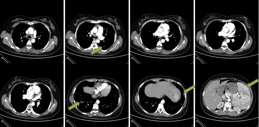 双肺多发结节，反复检查为何诊断重点成「盲区」？