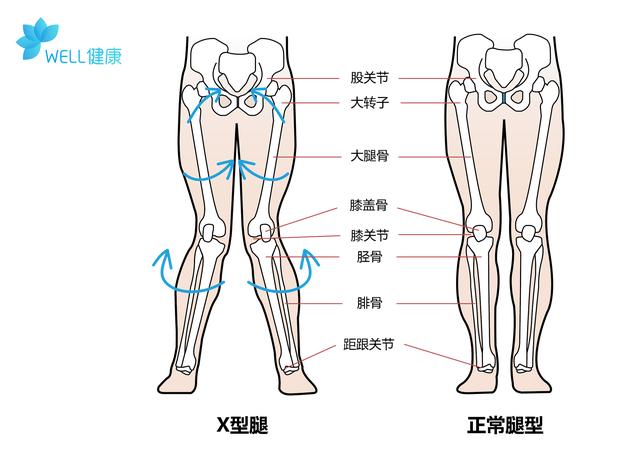 孩子x型腿应该怎么治疗,两岁孩子x型腿需要矫正吗